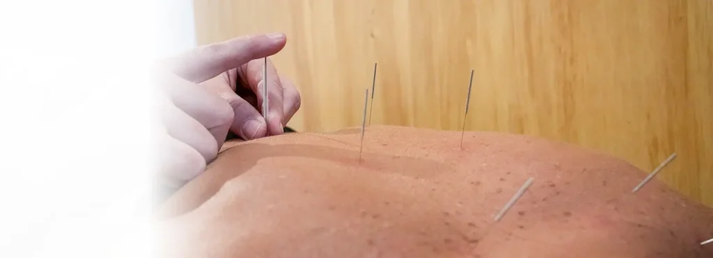 Acupuntura
